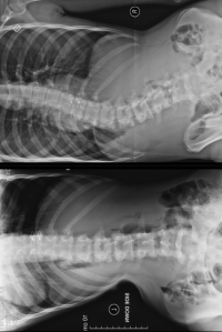 Scoliroll Scoliosis treatment