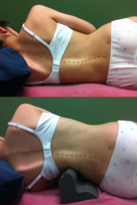 Scoliroll Scoliosis treatment